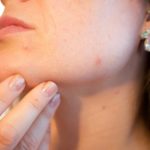 【痒疹・治らない湿疹の謎５】痒疹は改善悪化の繰り返しを辿るそう、その理由も明かします