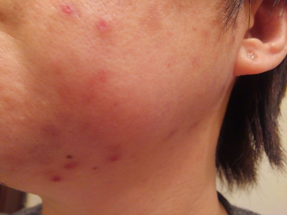 【痒疹・治らない湿疹の謎13】タクロリムス軟膏をひと月使い続けた皮膚状態お見せします左